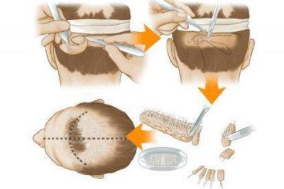 ​植发是用自己的头发移植吗 植发的危害和后遗症