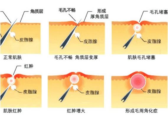 脸上有鸡皮肤怎么消除 脸上鸡皮肤怎么消除